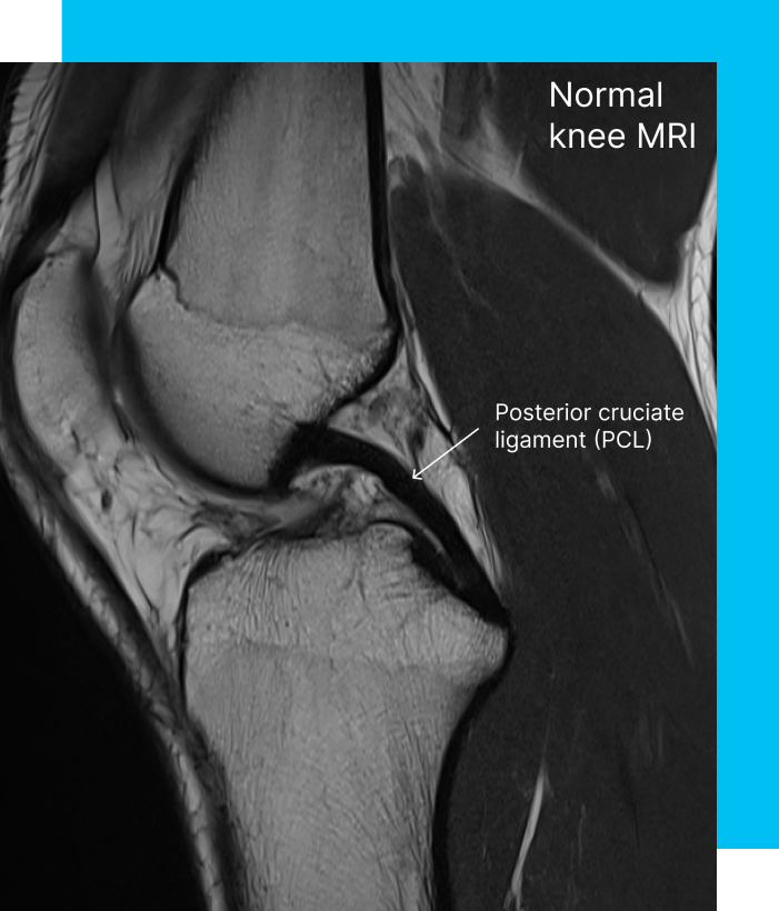 MRI of normal knee showing PCL.