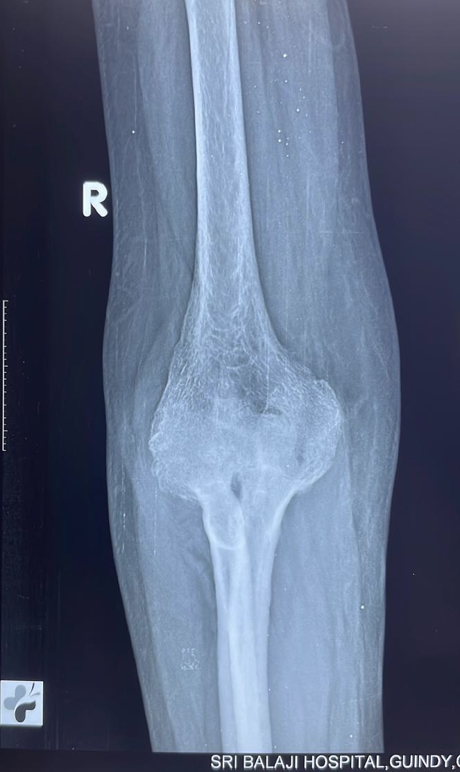 X-ray showing severe destruction of the right elbow joint in a patient.