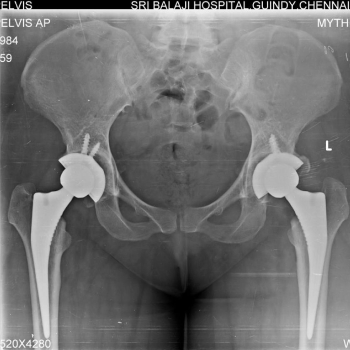 Hip Post-operation x-rays of both hips after replacement of both hips.